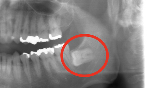 埋没した「親知らず」の摘出手術を受けました！